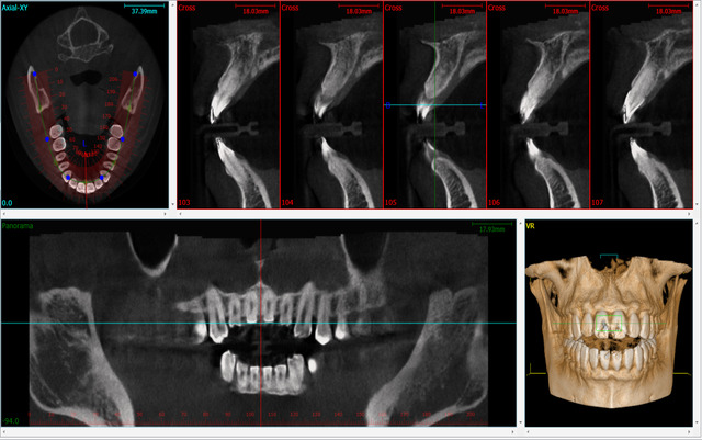 CBCT Scan