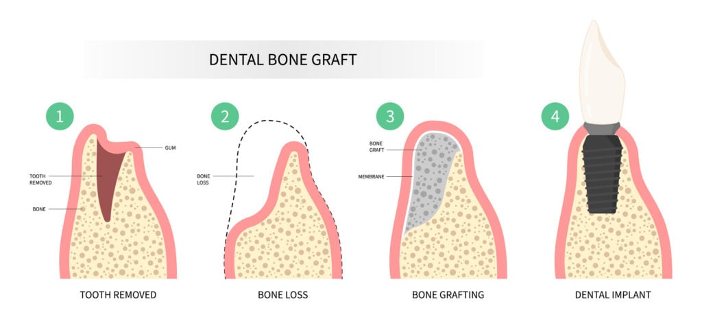 Dental bone graft in plymouth