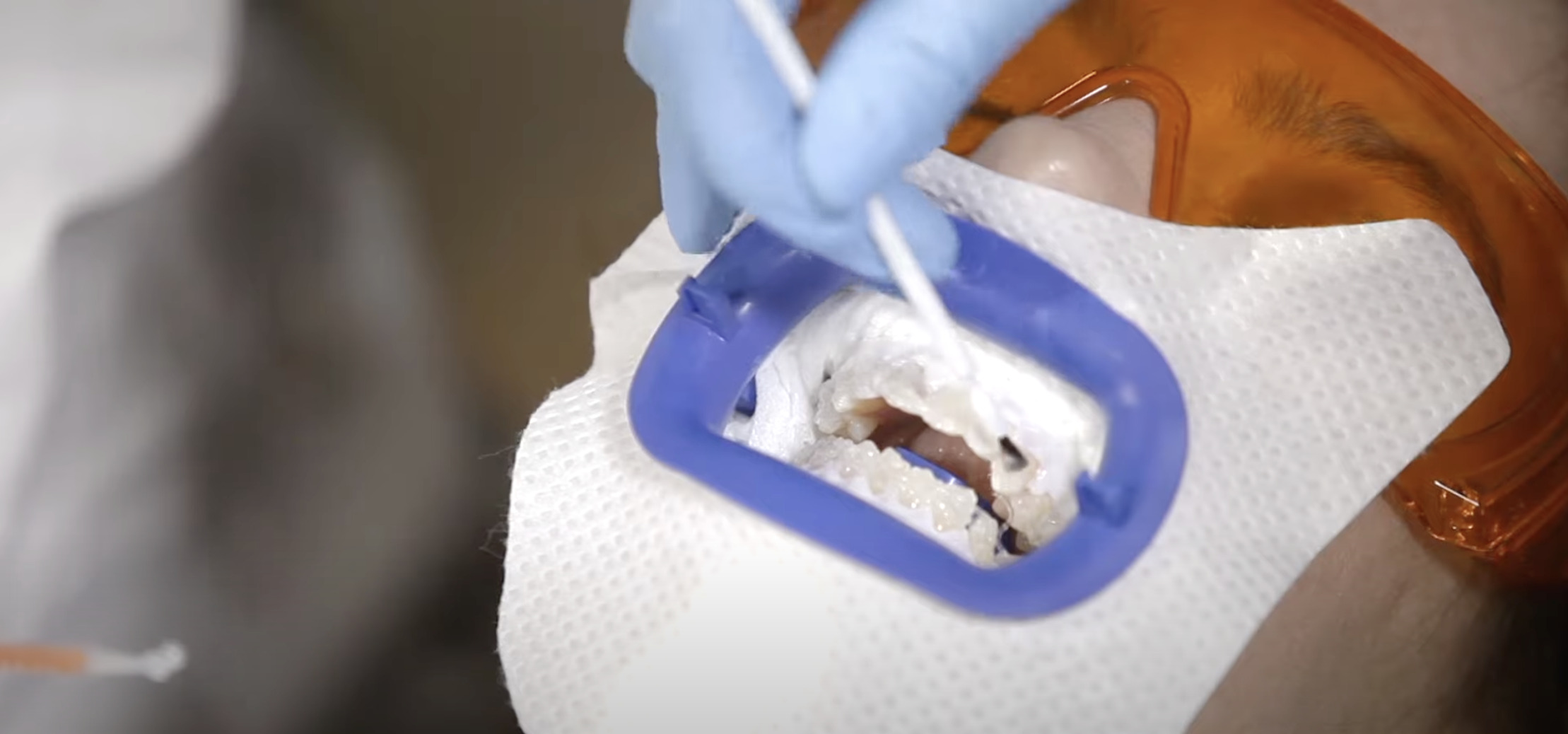 Philips Zoom tooth whitening tutorial