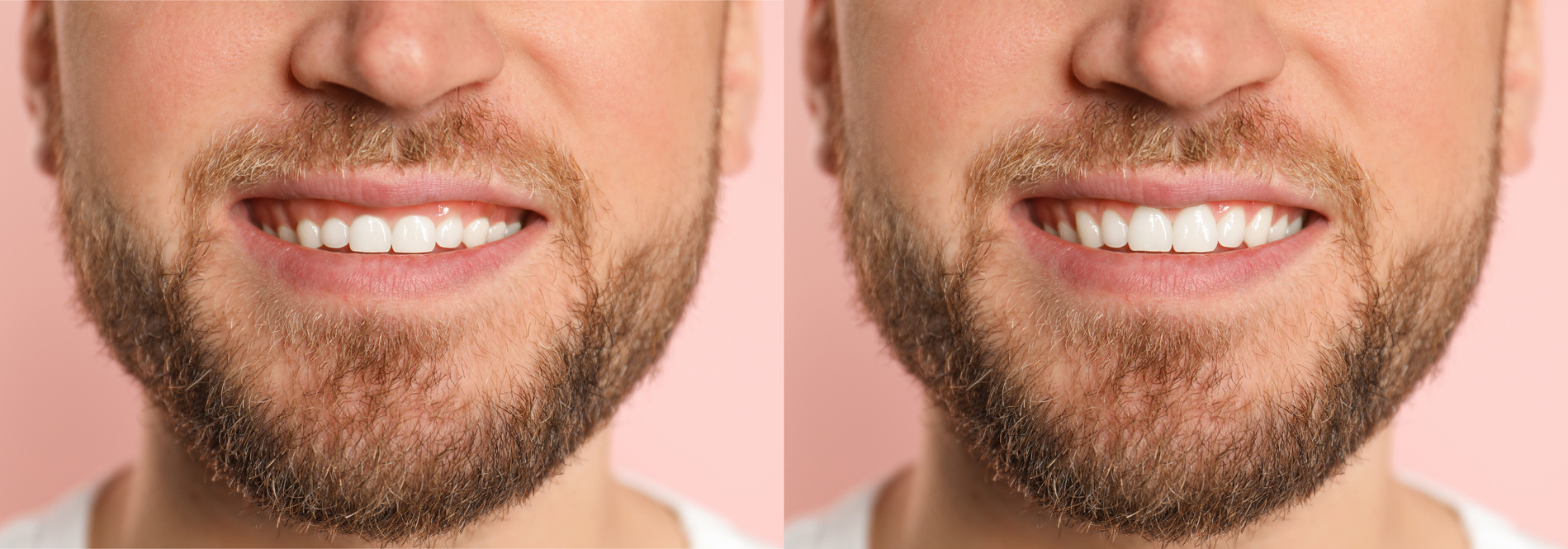 Gum Contouring Plymouth Laser gum reshaping procedures in Mannamead