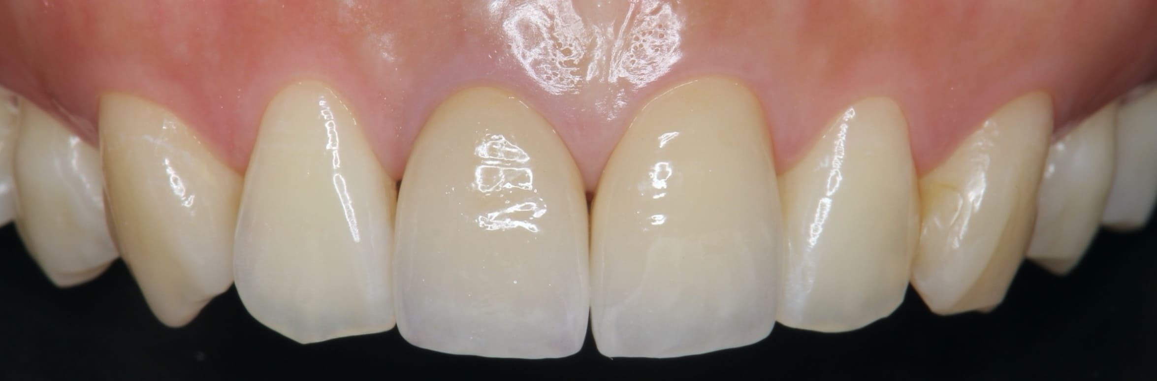 Dental Crowns Plymouth Singlevisit Ceramic Dental Crowns in