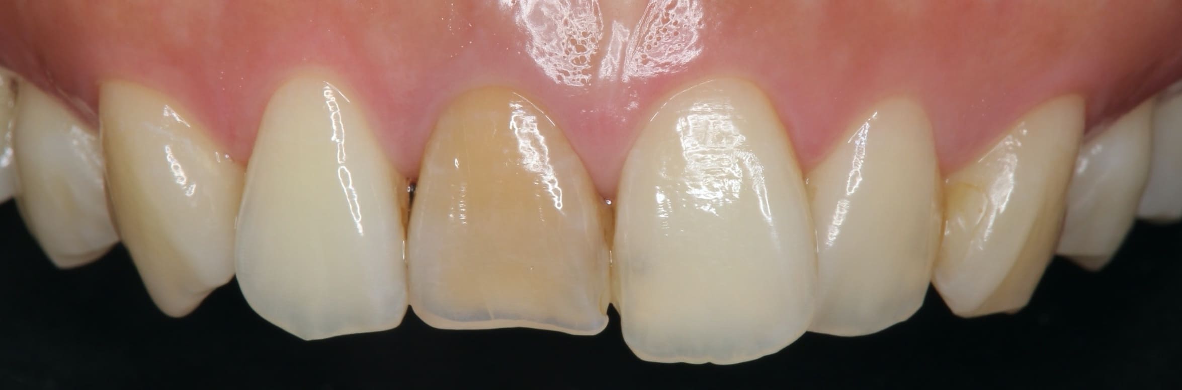 Dental Crowns Plymouth Singlevisit Ceramic Dental Crowns in