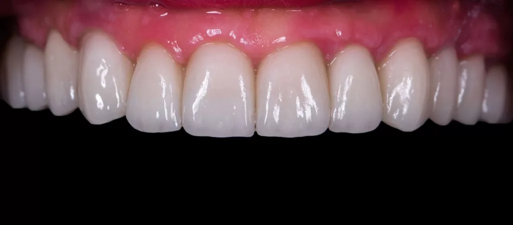 Dental implants front view after