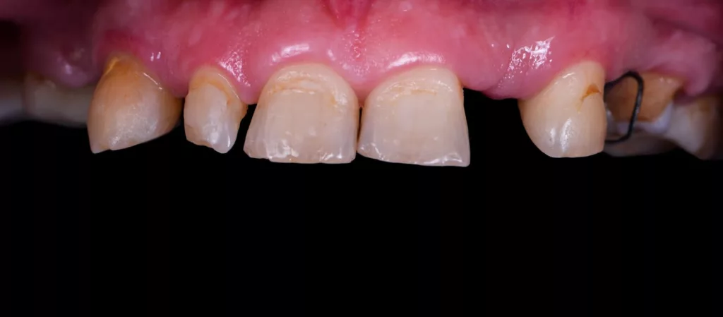 Dental implants front view before