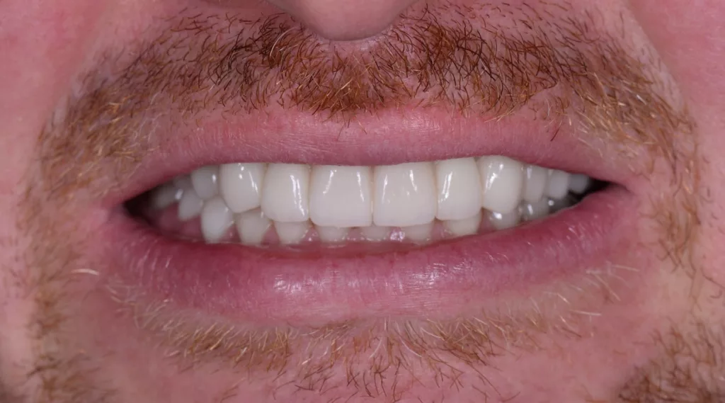 Dental implants front view after