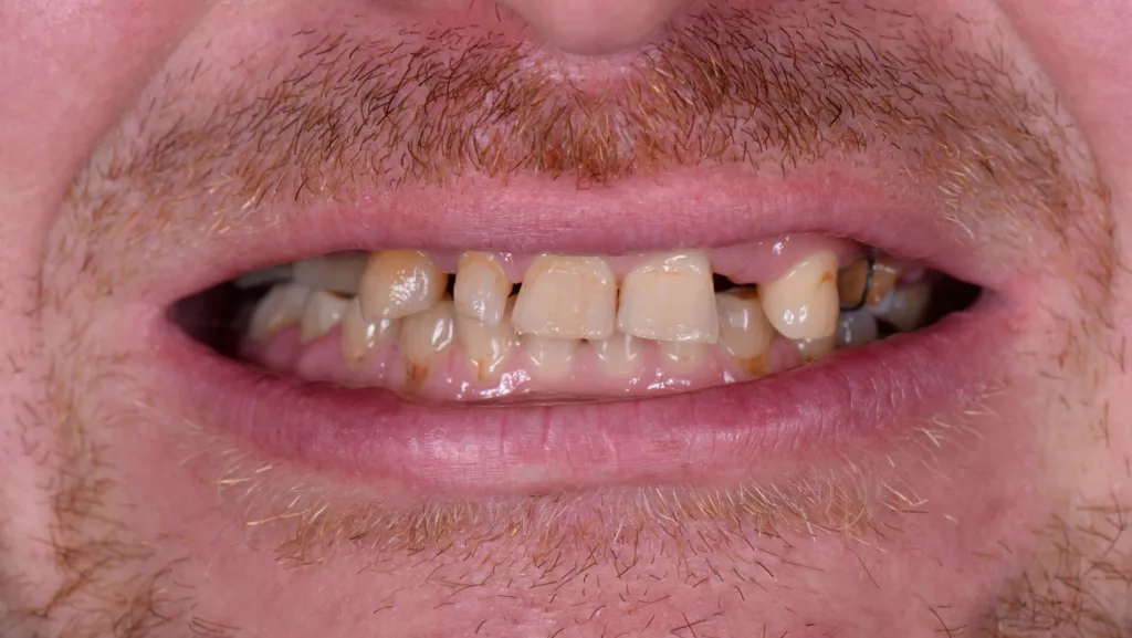Dental implants front view before