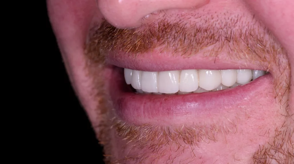 Dental implants side view after