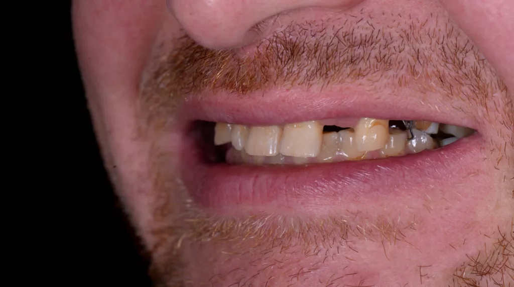 Dental implants side view before