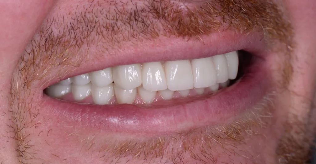 Dental implants side view after
