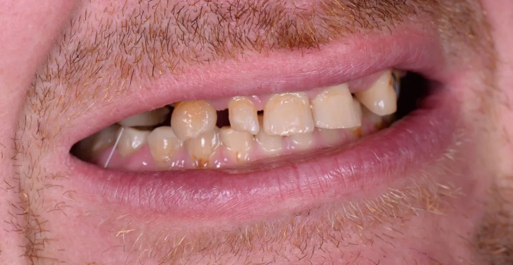 Dental implants side view before