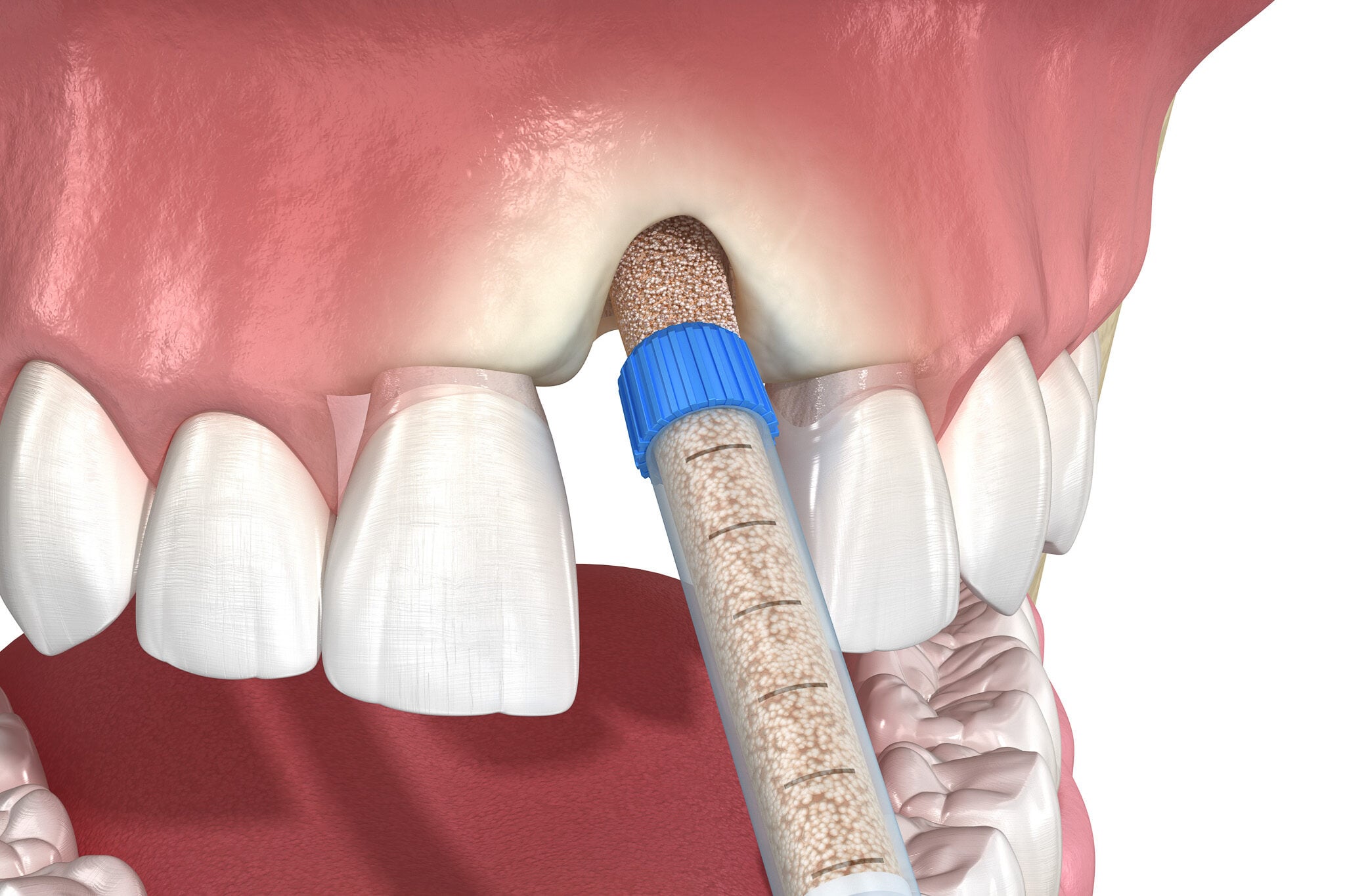 Bone Graft Plymouth